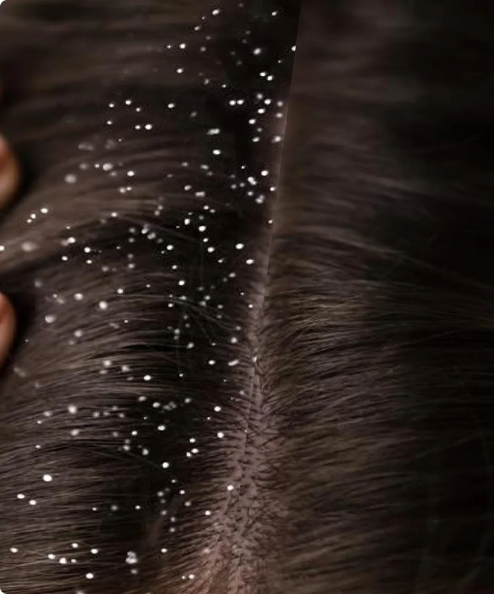 Dandruff Shampoo by NuMe