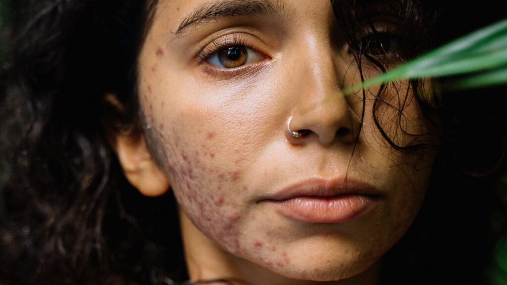 how to get rid of acne